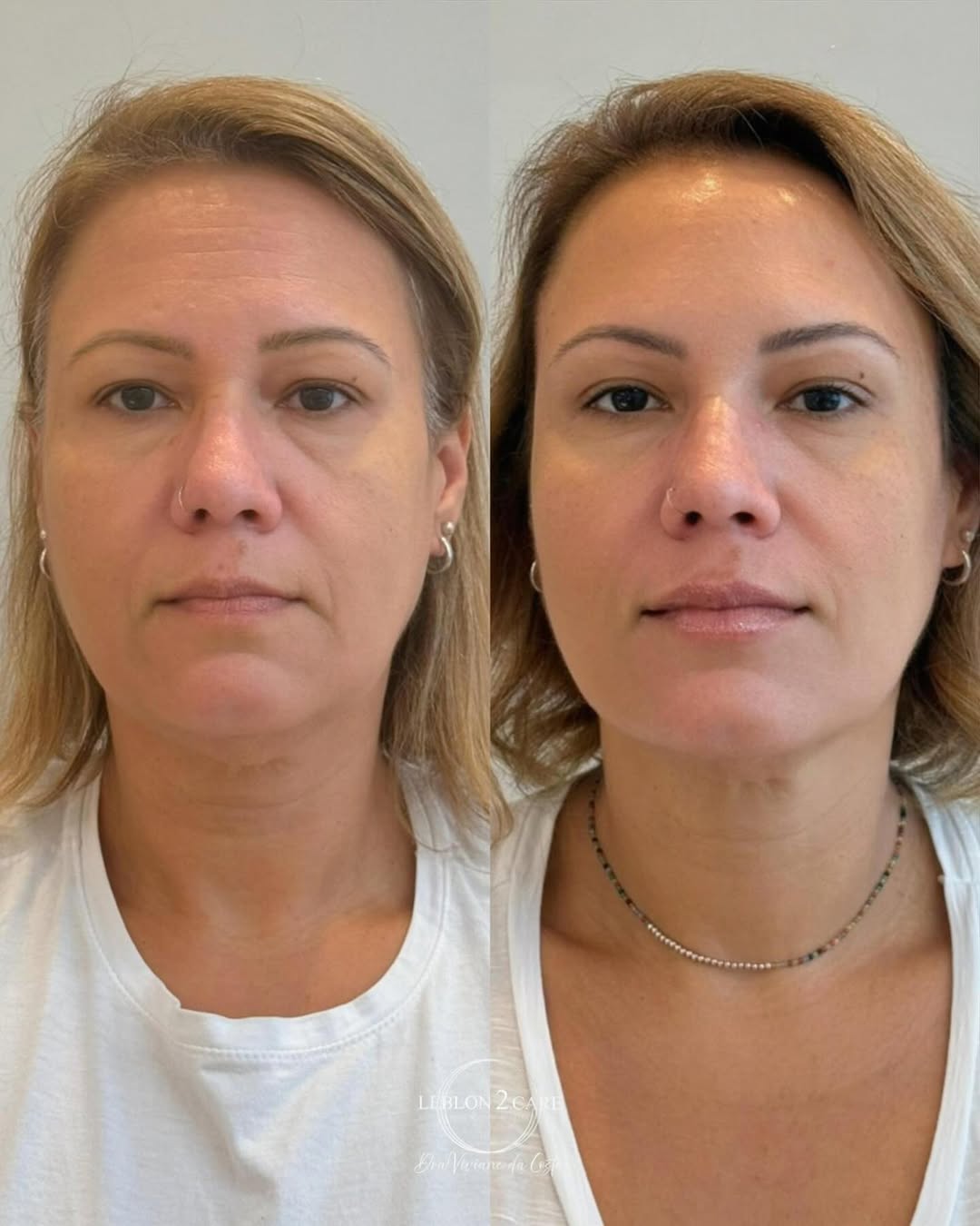 Harmonização Facial no Leblon - Dra Viviane da costa - Imagem 1